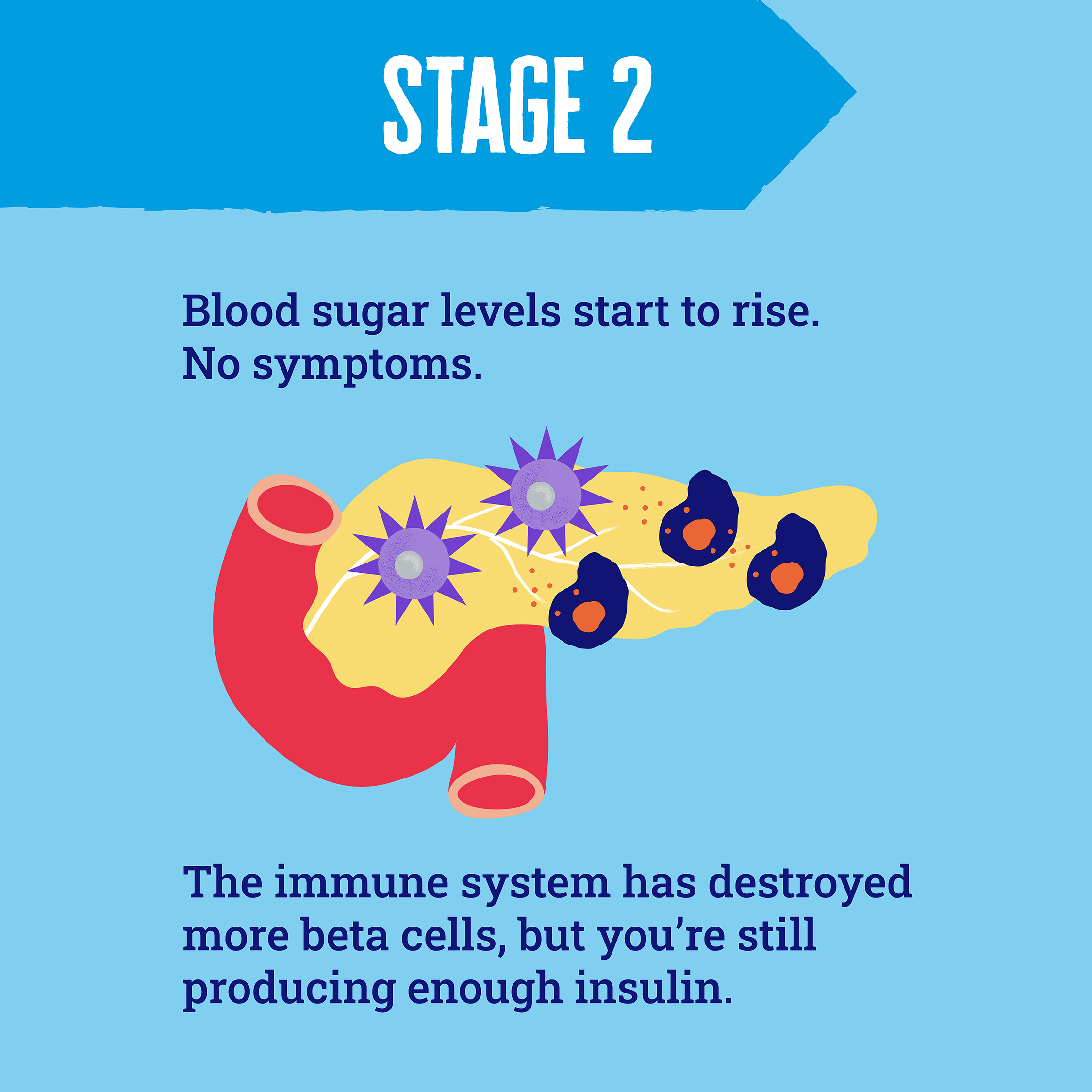 Illustration of fewer beta cells in a pancreas, with more attacking immune cells